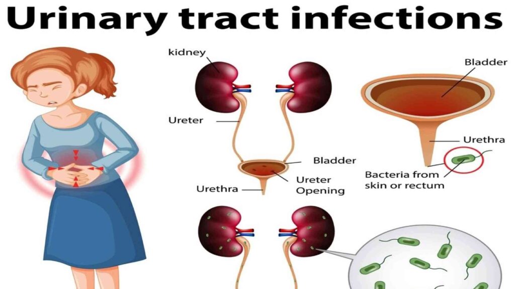 Urinary Tract Infection Treatment Tips That Work Like a Charm-compressed