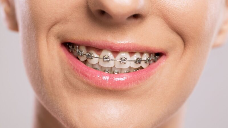 How Much are Braces in Canada?