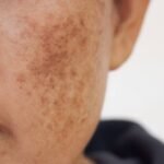 Why Does Melasma Occur During Pregnancy