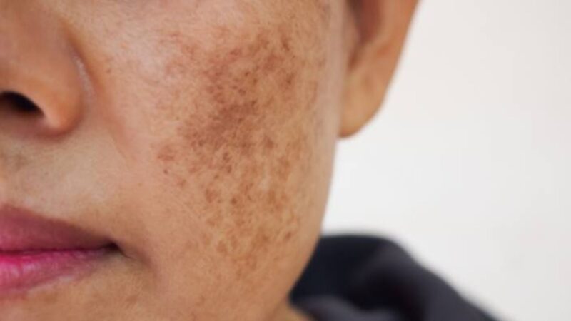 Why Does Melasma Occur During Pregnancy?