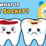 dry-socket-and-it-looks-like